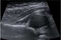 Ultrasound showing a dislocated hip
